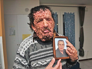 Man met neurofibromatose